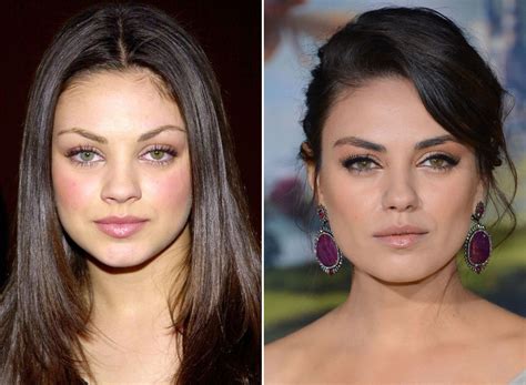 mila kunis buccal fat removal
